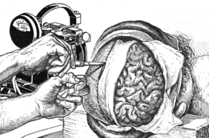 brain-implant